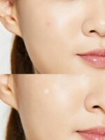 COSRX Acne Pimple Patch - Image 2
